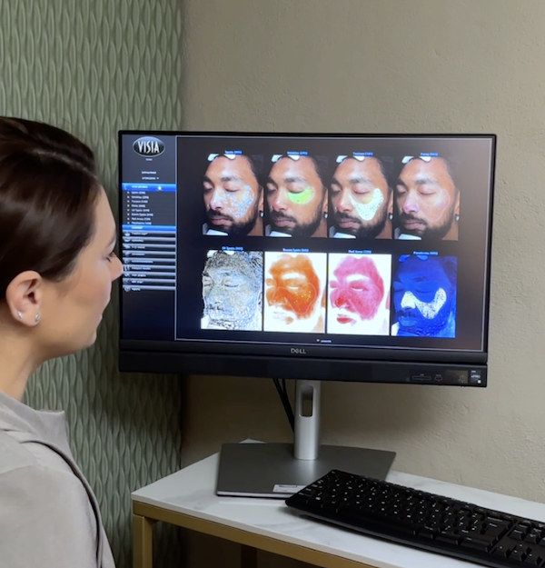 Visia Skin Analysis